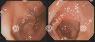 大肠水疗治疗前后镜检对比图