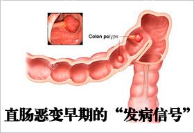 直肠恶变的症状和原因有哪些？