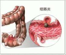 细说结肠炎的早期症状