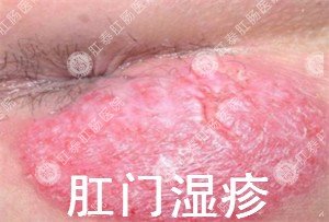 女性肛门湿疹会传染吗？