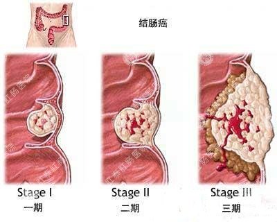 结肠炎