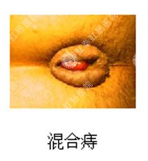 混合痔