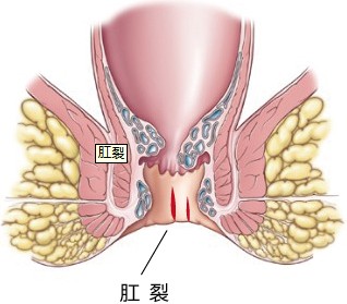 肛裂