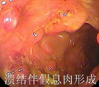 结肠炎