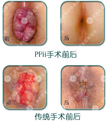 PPH手术与传统手术效果对比