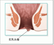 肛乳头瘤科普图