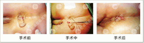肛乳头瘤切除结扎术过程图解