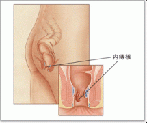 内痔示意图