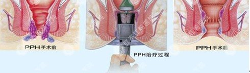 PPH手术过程示意图