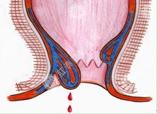 痔疮便血