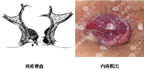 痔疮的危害