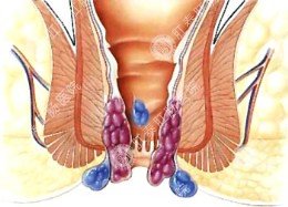 肛周脓肿走出治疗误区