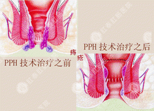 肛门疼痛肿胀，PPH创口微小祛除痔疮病痛