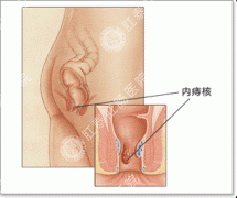 内痔发作怎么办之挑食没有错