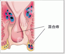 混合痔脱肛的治疗方法