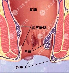 春季预防痔疮的不错方法