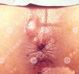 肛门脓肿的不同类型症状需分清