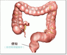 女性便秘的原因
