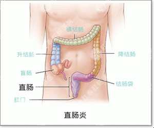 福州医博肛肠医院：得了急性肠炎怎么办？