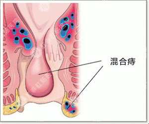 混合痔危害大，怎么治疗？