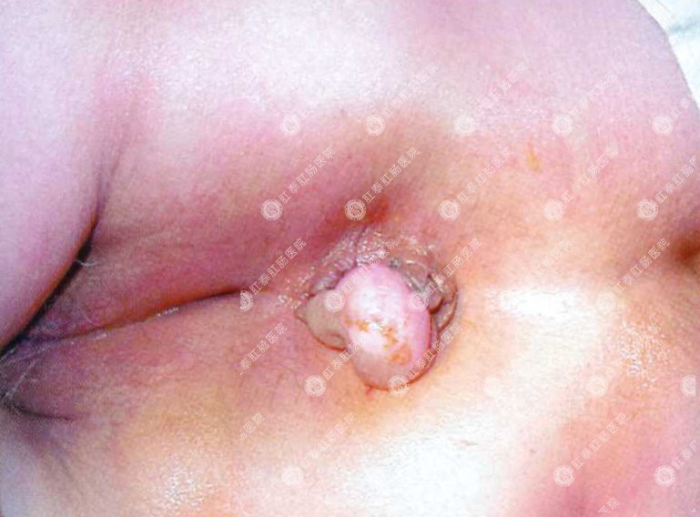 肛乳头肥大