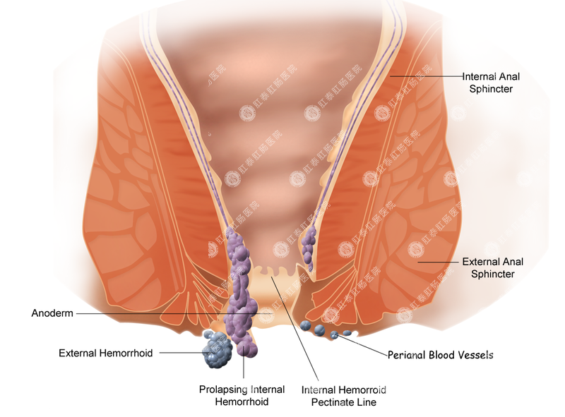 痔疮