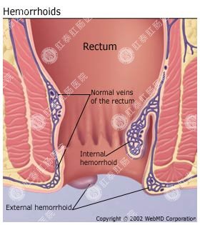 痔疮