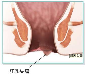肛乳头瘤