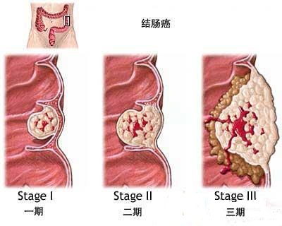 结肠肿瘤