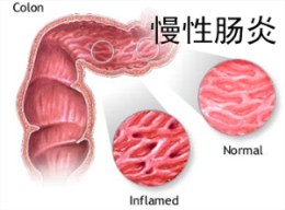 慢性肠炎