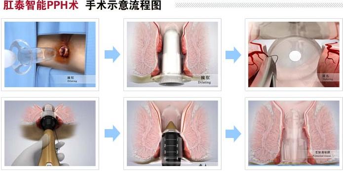 PPH创口微小方法