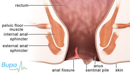 肛裂